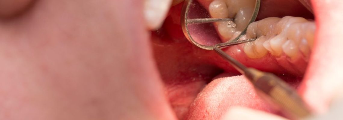 El viaje de una caries una historia con distintos finales
