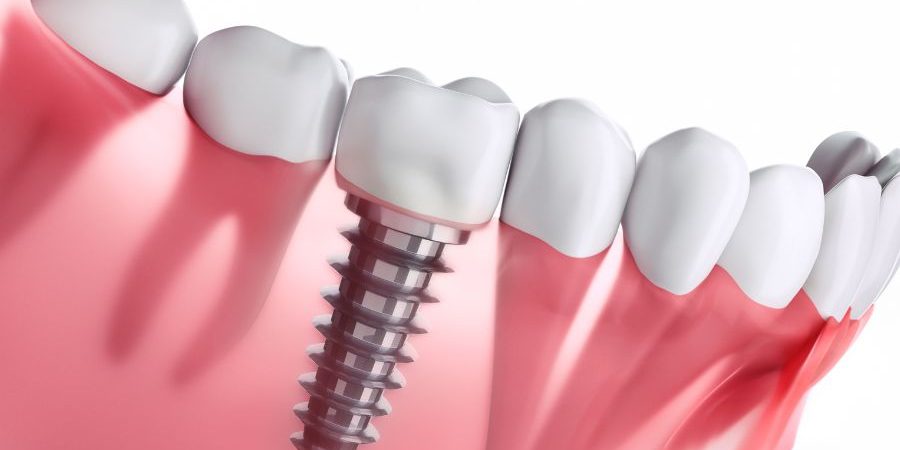 Implante dental en Burgos